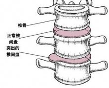 腰椎间盘突出的显著症状有哪些